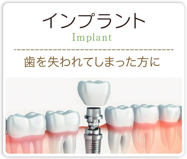 インプラント