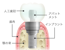 インプラント