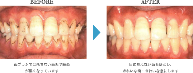 プロフェッショナルクリーニングの BEFOR AFTER