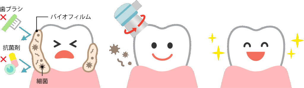 西宮北口 歯医者 クリーニング