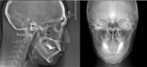 歯科矯正骨格診断
