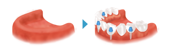歯を1本失った場合のインプラント治療
