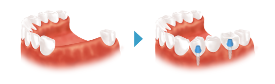 歯を数本失った場合のインプラント治療