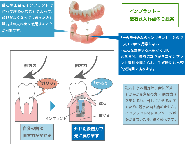 インプラント＋磁石式入れ歯のご提案