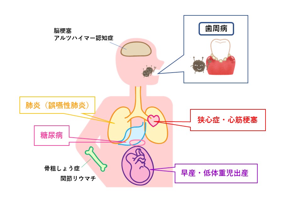 西宮北口　歯医者　歯周病は口の中だけではなく、実は全身の健康に影響するんです！