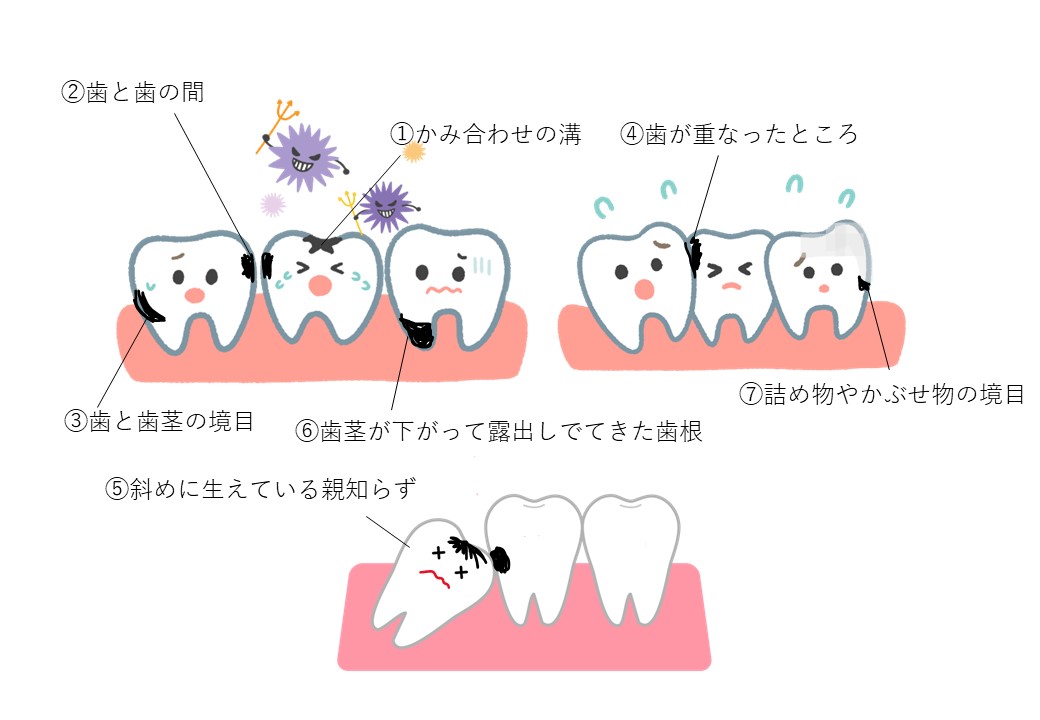 西宮北口　歯医者　虫歯になりやすい場所　