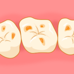 西宮北口　歯医者　酸蝕症の歯