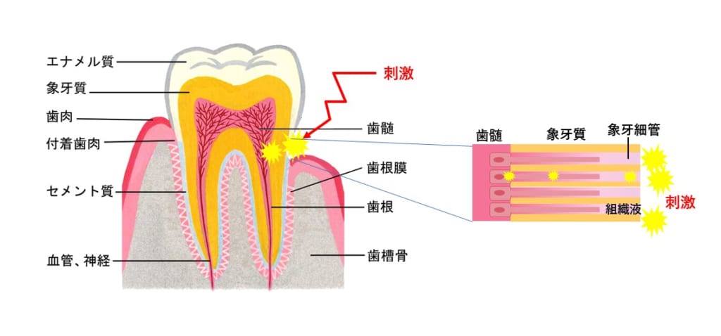 西宮北口　歯医者　知覚過敏