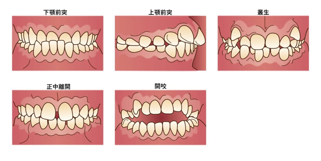 西宮北口　歯医者　不正咬合