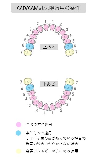 CAD/CAM冠保険適用条件　西宮北口　歯医者