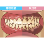 西宮北口　歯医者　喫煙者と非喫煙者の口腔