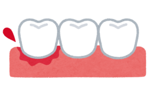 西宮北口　歯医者　歯肉出血