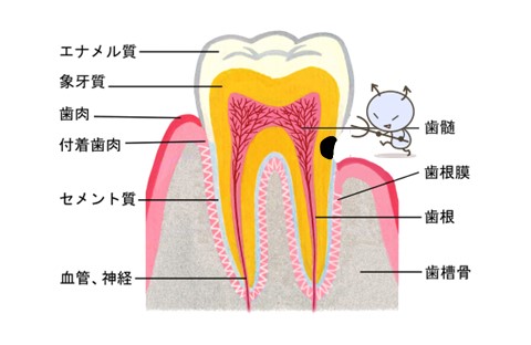 西宮北口　歯医者　根面う蝕