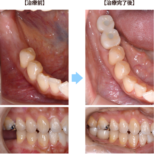 インプラント症例