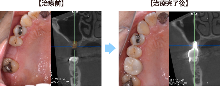 インプラントの症例
