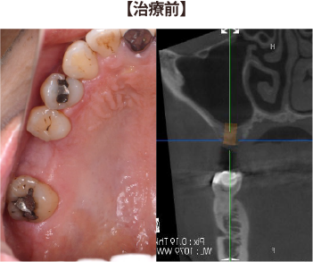 インプラントの症例