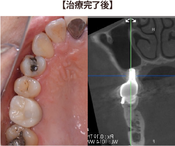 インプラントの症例