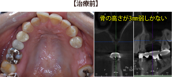 implant_case_3_before
