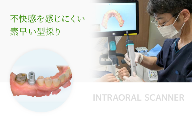 口腔内スキャナー「iTero Lumina」