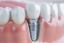 imp_img_4 インプラント