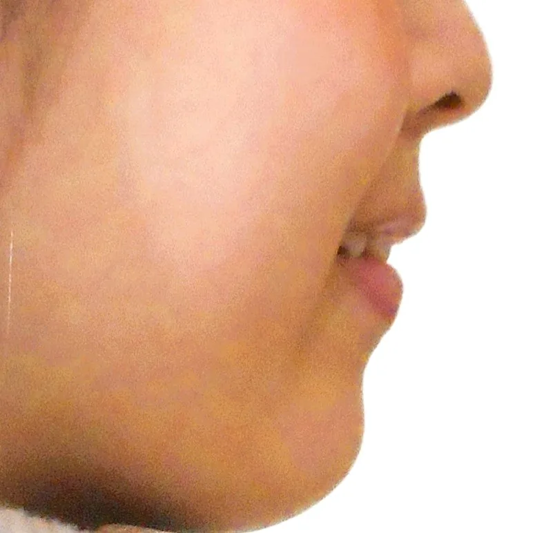 症例① 治療前の横顔